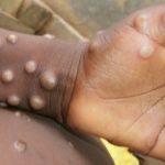 Monkeypox Outbreak in India: ‘Suspected Cases To Be Isolated at Kasturba Hospital, Test Samples Will Be Sent to NIV Pune’, Says BMC